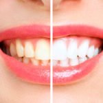 Blanqueamiento Dental en Alcobendas y San Sebastián de los Reyes