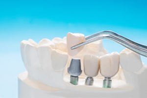 Prótesis dentales ¿Qué son?