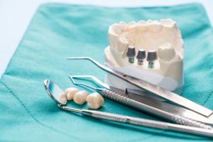 La importancia de los implantes dentales.