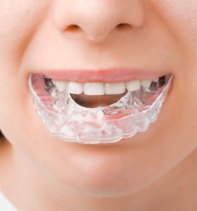 Ventajas de tener una férula de descarga para bruxismo