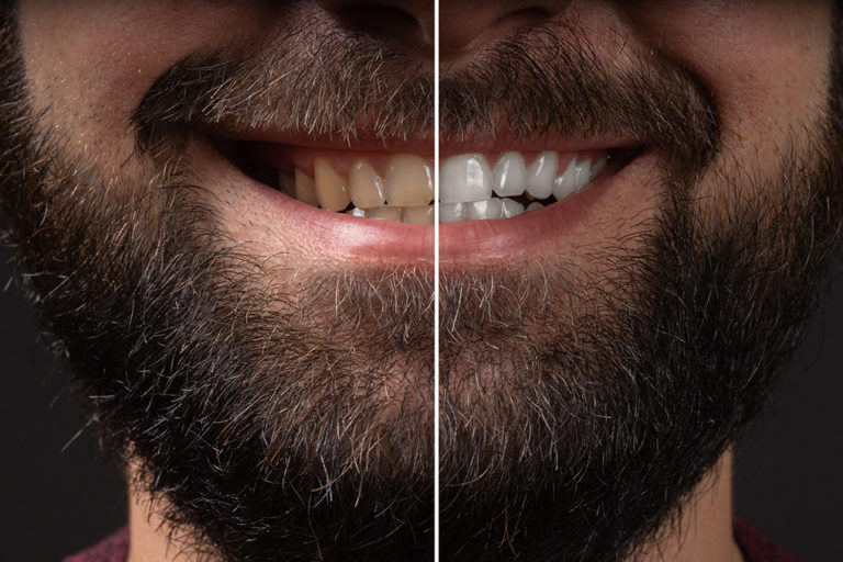 smiling man before and after teeth whitening procedure closeup whitening teeth laser bleach in male 768x512